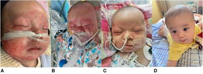 Fever, convulsions, and rash: a case report of neonatal lupus erythematosus with macrophage activation syndrome